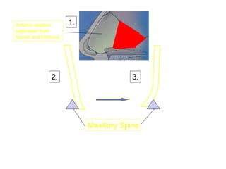Maxillary Spine
1.
2. 3.
Anterior septum
separated from
Vomer and Ethmoid
 