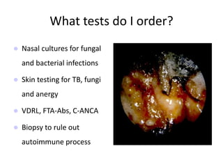 What tests do I order?
 Nasal cultures for fungal
and bacterial infections
 Skin testing for TB, fungi
and anergy
 VDRL, FTA-Abs, C-ANCA
 Biopsy to rule out
autoimmune process
 