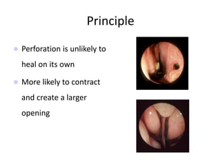 Principle
 Perforation is unlikely to
heal on its own
 More likely to contract
and create a larger
opening
 