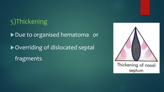 5)Thickening
Due to organised hematoma or
Overriding of dislocated septal
fragments.
 
