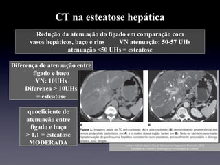 CT na esteatose hepática
Redução da atenuação do fígado em comparação com
vasos hepáticos, baço e rins VN atenuação: 50-57 UHs
atenuação <50 UHs = esteatose
Diferença de atenuação entre
fígado e baço
VN: 10UHs
Diferença > 10UHs
= esteatose
quoeficiente de
atenuação entre
fígado e baço
> 1,1 = esteatose
MODERADA Andreia Andrade Santos, Tese de Mestrado em Engenharia Biomedica, 2012
Faculdade de Ciencias e Tecnologia da Universidade de Coimbra
 