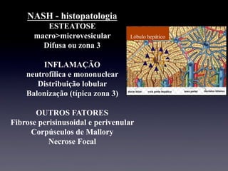 NASH - histopatologia
ESTEATOSE
macro>microvesicular
Difusa ou zona 3
INFLAMAÇÃO
neutrofílica e mononuclear
Distribuição lobular
Balonização (típica zona 3)
OUTROS FATORES
Fibrose perisinusoidal e perivenular
Corpúsculos de Mallory
Necrose Focal
Lóbulo hepático
 