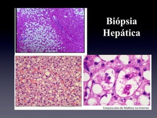 Biópsia
Hepática
 
