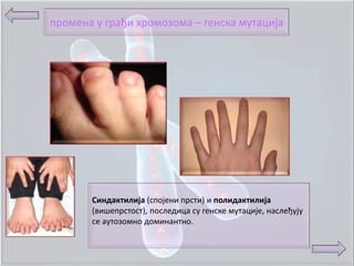 прпмена у грађи хрпмпзпма – генска мутација




       Синдактилија (сппјени прсти) и полидактилија
       (вишепрстпст), ппследица су генске мутације, наслеђују
       се аутпзпмнп дпминантнп.
 