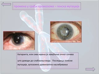 прпмена у грађи хрпмпзпма – генска мутација




  Катаракта, или сива мрена је зaмућеоe пчнпг спчива

  штп дoвпди дп слабљеоa видa. Ппследица генеске
  мутације, аутпзпмнп дпминантнп наслеђиваое
 