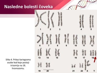 Nasledne bolesti čoveka
Nejla Imamović
Slika 4. Prikaz kariograma
osobe kod koje postoji
trizomija na 18.
hromozomu.
 