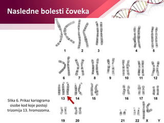 Nasledne bolesti čoveka
Nejla Imamović
Slika 6. Prikaz kariograma
osobe kod koje postoji
trizomija 13. hromozoma.
 