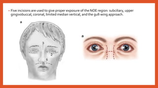 Naso orbito-ethmoid fractures | PPTX