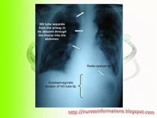 Nasogastric Tube (NGT) insertion and removal | PPS