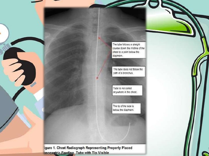 Nasogastric intubation