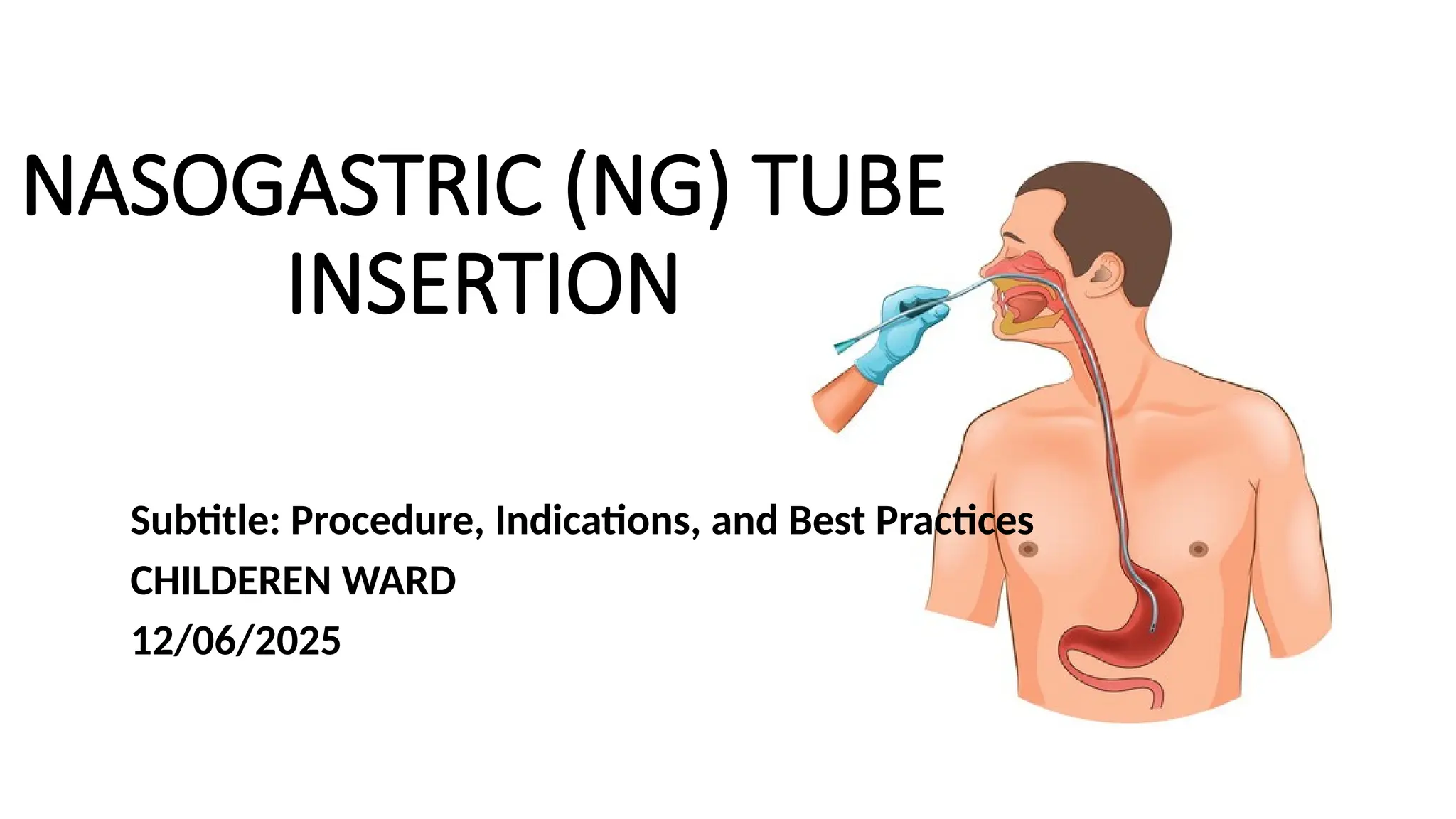 Ng Tube Practice NASOGASTRIC (NG) TUBE INSERTION in pediatric patients | PPTX