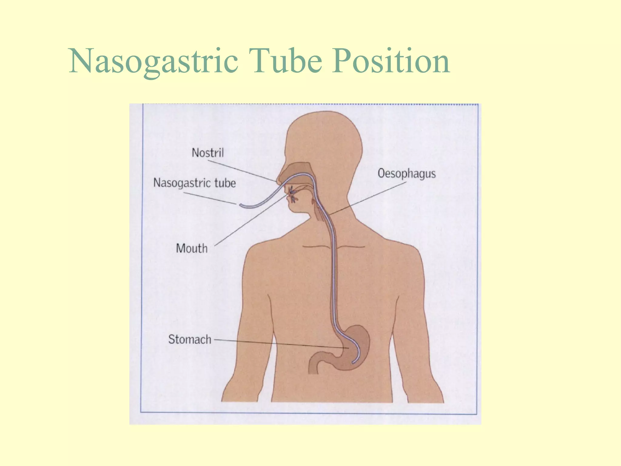 Nasogastric tube insertion | PPT