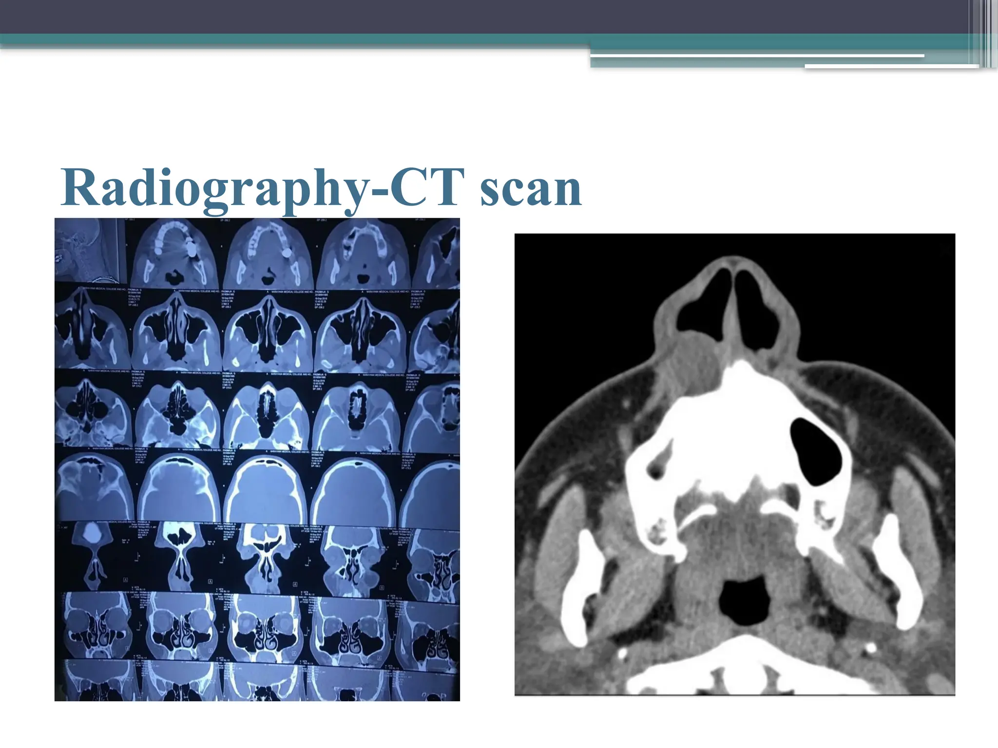 NASOLABIAL CYST.pptx and it’s mangment ,excision | PPTX