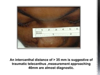 NOE FRACTURE PPT | PPTX