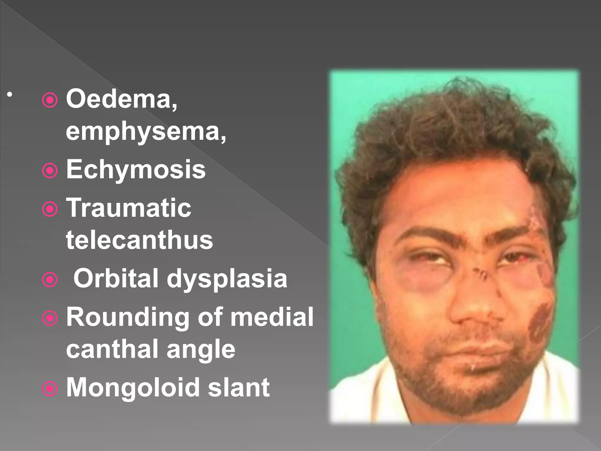 Naso orbito ethmoidal fracture | PPTX