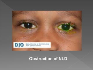Obstruction of NLD
 
