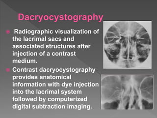  Radiographic visualization of
the lacrimal sacs and
associated structures after
injection of a contrast
medium.
 Contrast dacryocystography
provides anatomical
information with dye injection
into the lacrimal system
followed by computerized
digital subtraction imaging.
 