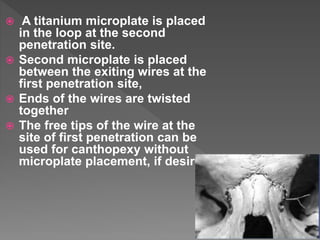  A titanium microplate is placed
in the loop at the second
penetration site.
 Second microplate is placed
between the exiting wires at the
first penetration site,
 Ends of the wires are twisted
together
 The free tips of the wire at the
site of first penetration can be
used for canthopexy without
microplate placement, if desired.
 