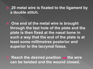  20 metal wire is fixated to the ligament by
a double stitch.
 One end of the metal wire is brought
through the last hole of the plate and the
plate is then fixed at the nasal bone in
such a way that the end of the plate is at
least some millimetres posterior and
superior to the lacrymal fossa.
 Reach the desired position the wire
can be twisted and the wound closed.
 