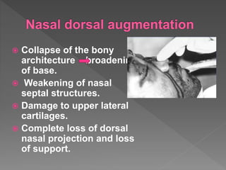  Collapse of the bony
architecture broadening
of base.
 Weakening of nasal
septal structures.
 Damage to upper lateral
cartilages.
 Complete loss of dorsal
nasal projection and loss
of support.
 