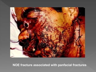 NOE fracture associated with panfacial fractures
 