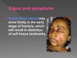 Gross facial edema may
show firstly in the early
stage of fracture, which
will result in distortion
of soft tissue landmarks.
 