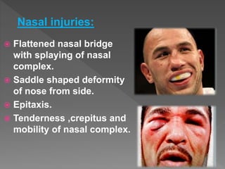  Flattened nasal bridge
with splaying of nasal
complex.
 Saddle shaped deformity
of nose from side.
 Epitaxis.
 Tenderness ,crepitus and
mobility of nasal complex.
Nasal injuries:
 