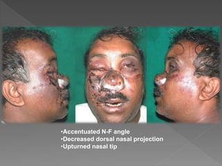 •Accentuated N-F angle
•Decreased dorsal nasal projection
•Upturned nasal tip
 