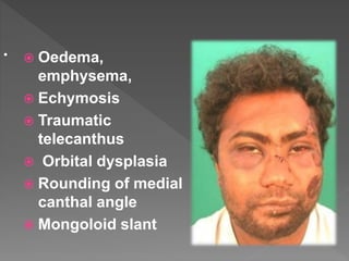 •  Oedema,
emphysema,
 Echymosis
 Traumatic
telecanthus
 Orbital dysplasia
 Rounding of medial
canthal angle
 Mongoloid slant
 