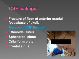  Fracture of floor of anterior cranial
fossa/base of skull.
Escape of CSF through
 Ethmoidal sinus
 Sphenoidal sinus
 Cribriform plate
 Frontal sinus
 