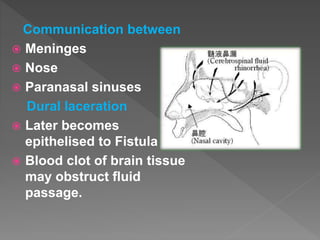 Communication between
 Meninges
 Nose
 Paranasal sinuses
Dural laceration
 Later becomes
epithelised to Fistula
 Blood clot of brain tissue
may obstruct fluid
passage.
 