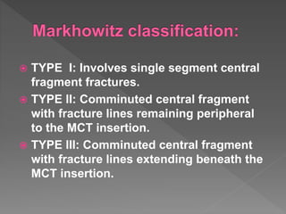  TYPE I: Involves single segment central
fragment fractures.
 TYPE II: Comminuted central fragment
with fracture lines remaining peripheral
to the MCT insertion.
 TYPE III: Comminuted central fragment
with fracture lines extending beneath the
MCT insertion.
 