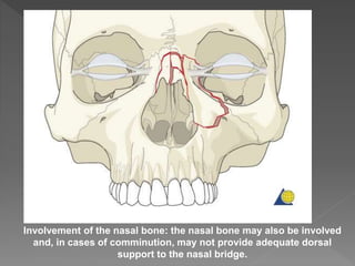 Involvement of the nasal bone: the nasal bone may also be involved
and, in cases of comminution, may not provide adequate dorsal
support to the nasal bridge.
 