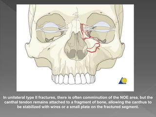In unilateral type II fractures, there is often comminution of the NOE area, but the
canthal tendon remains attached to a fragment of bone, allowing the canthus to
be stabilized with wires or a small plate on the fractured segment.
 