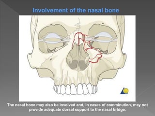 The nasal bone may also be involved and, in cases of comminution, may not
provide adequate dorsal support to the nasal bridge.
Involvement of the nasal bone
 