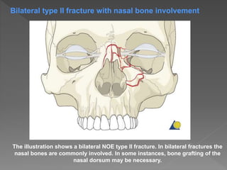 The illustration shows a bilateral NOE type II fracture. In bilateral fractures the
nasal bones are commonly involved. In some instances, bone grafting of the
nasal dorsum may be necessary.
Bilateral type II fracture with nasal bone involvement
 