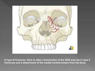 In type III fractures, there is often comminution of the NOE area (as in type II
fractures) and a detachment of the medial canthal tendon from the bone.
 