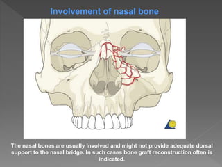 The nasal bones are usually involved and might not provide adequate dorsal
support to the nasal bridge. In such cases bone graft reconstruction often is
indicated.
Involvement of nasal bone
 