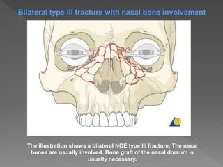 The illustration shows a bilateral NOE type III fracture. The nasal
bones are usually involved. Bone graft of the nasal dorsum is
usually necessary.
Bilateral type III fracture with nasal bone involvement
 