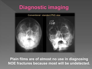 Plain films are of almost no use in diagnosing
NOE fractures because most will be undetected.
 