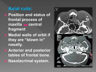 Axial cuts:
 Position and status of
frontal process of
maxilla central
fragment
 Medial walls of orbit if
they are “blown in”
nasally.
 Anterior and posterior
tables of frontal bone.
 Nasolacrimal system.
 