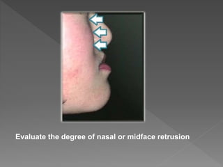 Evaluate the degree of nasal or midface retrusion
 