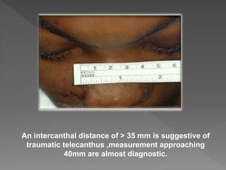 An intercanthal distance of > 35 mm is suggestive of
traumatic telecanthus ,measurement approaching
40mm are almost diagnostic.
 