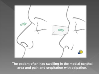 The patient often has swelling in the medial canthal
area and pain and crepitation with palpation.
 