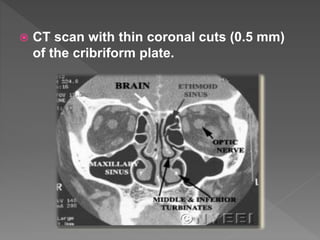  CT scan with thin coronal cuts (0.5 mm)
of the cribriform plate.
 