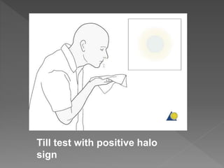 Till test with positive halo
sign
 