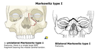 In unilateral Markowitz type I
fractures, there is a single large NOE
fragment bearing the medial canthal tendon.
Markowitz type I
Bilateral Markowitz type I
fractures,
 