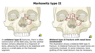 In unilateral type II fractures, there is often
comminution of the NOE area, but the canthal
tendon remains attached to a fragment of
bone, allowing the canthus to be stabilized with
wires or a small plate on the fractured
segment.
Bilateral type II fracture with nasal bone
involvement
The illustration shows a bilateral NOE type II
fracture. In bilateral fractures the nasal bones are
commonly involved. In some instances, bone
grafting of the nasal dorsum may be necessary.
Markowitz type II
 