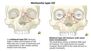 In unilateral type III fractures,
there is often comminution of the
NOE area (as in type II fractures) and
a detachment of the medial canthal
tendon from the bone.
Bilateral type III fracture with nasal
bone involvement
The illustration shows a bilateral NOE type
III fracture. The nasal bones are usually
involved. Bone graft of the nasal dorsum is
usually necessary.
Markowitz type III
 