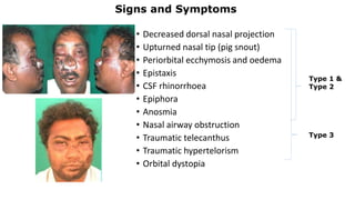 Signs and Symptoms
• Decreased dorsal nasal projection
• Upturned nasal tip (pig snout)
• Periorbital ecchymosis and oedema
• Epistaxis
• CSF rhinorrhoea
• Epiphora
• Anosmia
• Nasal airway obstruction
• Traumatic telecanthus
• Traumatic hypertelorism
• Orbital dystopia
Type 1 &
Type 2
Type 3
 